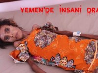 Yemen’de yetersiz beslenme ve açlığın fotoğrafı